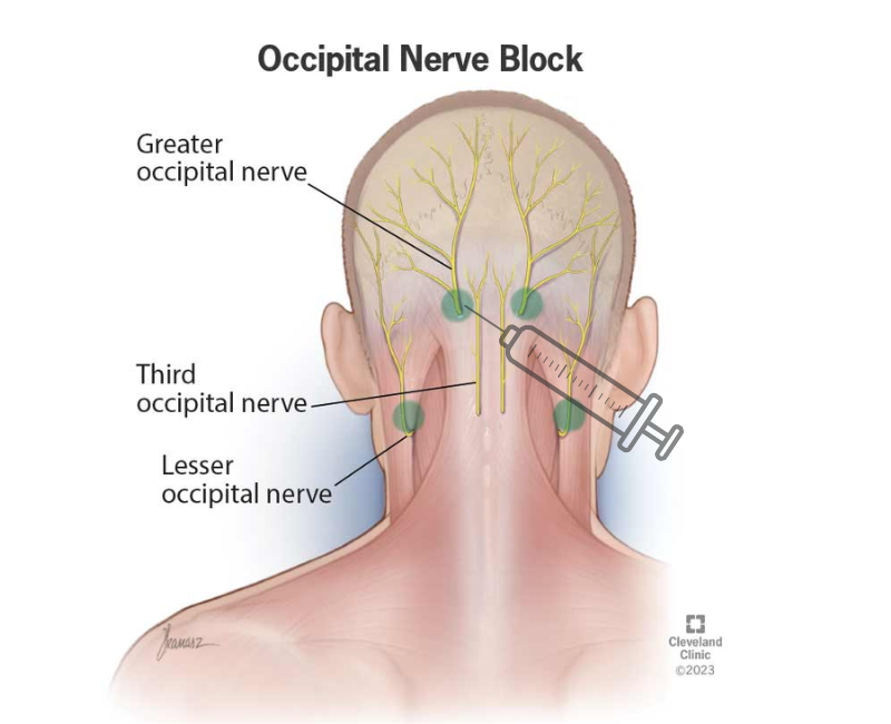 Occipital Nerve Blocks (ONB) in Jacksonville, FL