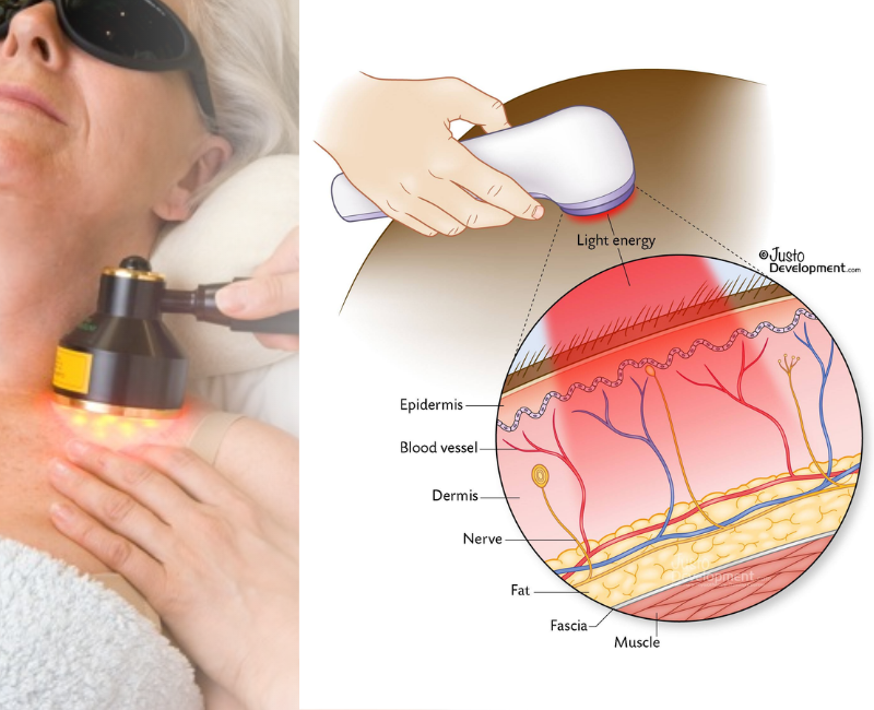 Photobiomodulation Therapy in Jacksonville, FL