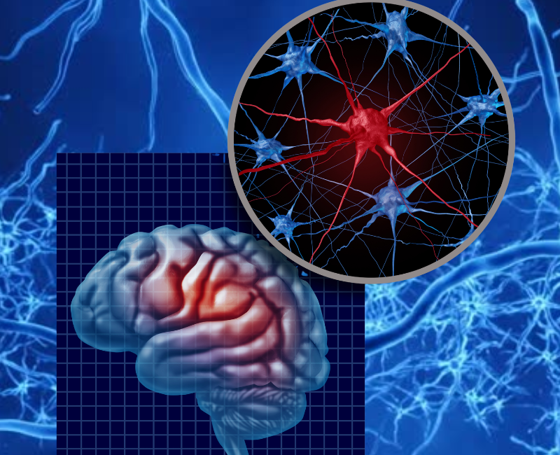Sphenopalatine Ganglion Nerve Block (SPG)