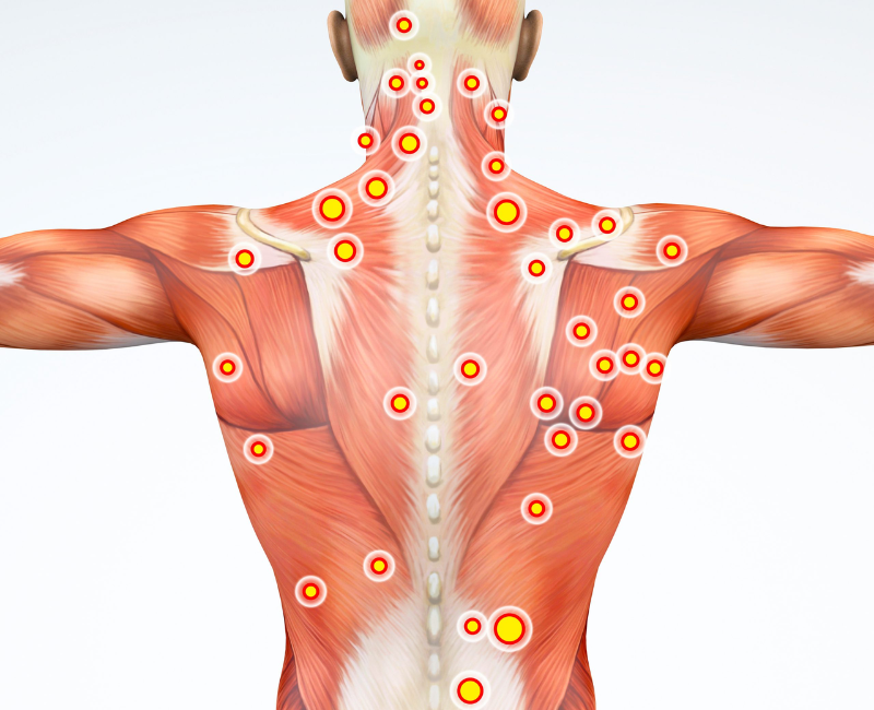Trigger Point Injections (TPI) in Jacksonville, FL
